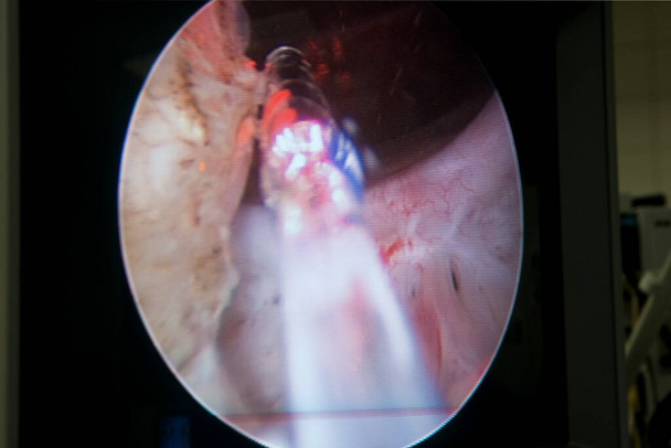 Laser surgery for treatment of benign prostatic hyperplasia, endoscopic image. - Foto, Imagem
