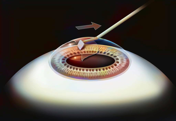 Eye, surgery, Lasek step 2: the corneal epithelium layer is detached. - 写真・画像