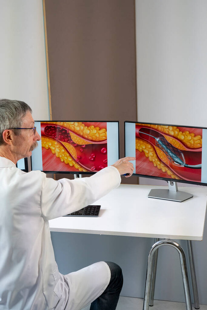 A doctor showing atheroma plaque and stent placement images on computer screens. - Zdjęcie, obraz