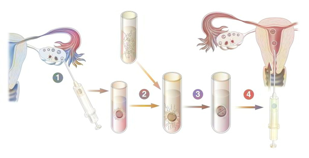 Diagram of the different stages of in vitro fertilization. - 写真・画像