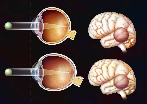 Σύγκριση μεταξύ φυσιολογικής όρασης και μυωπικής όρασης. - Φωτογραφία, εικόνα