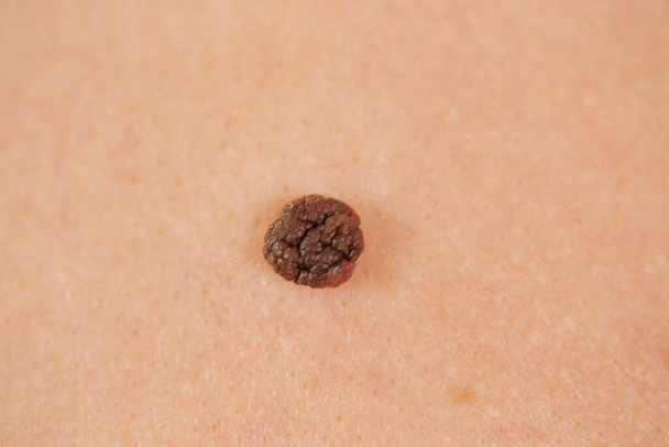 mole on skin close-up view - Zdjęcie, obraz
