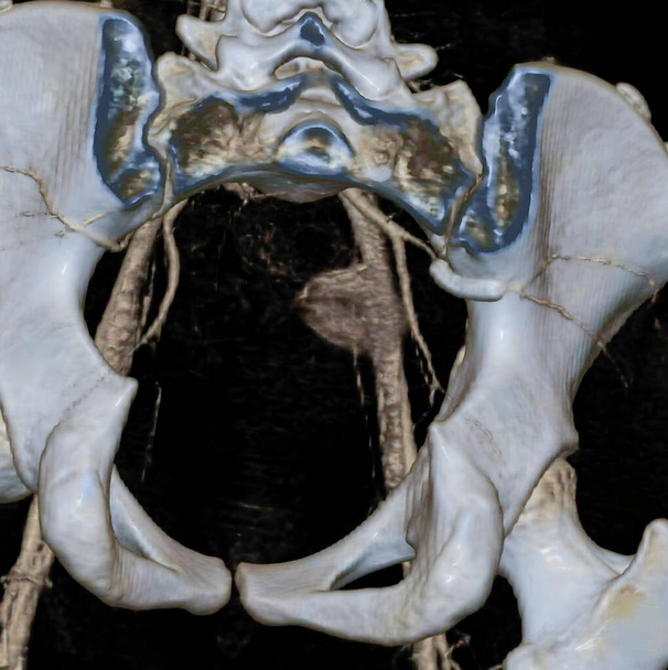 Pelvis and iliac arteries are visible, as well as a stent in the gluteal artery. 3D CT scan. - 写真・画像
