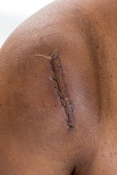 cicatriz de operação com uma fibra preta na pele preta
 - Foto, Imagem