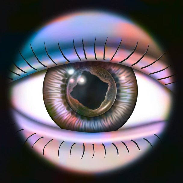 Eye with secondary cataract treated with YAG laser. - Fotografie, Obrázek