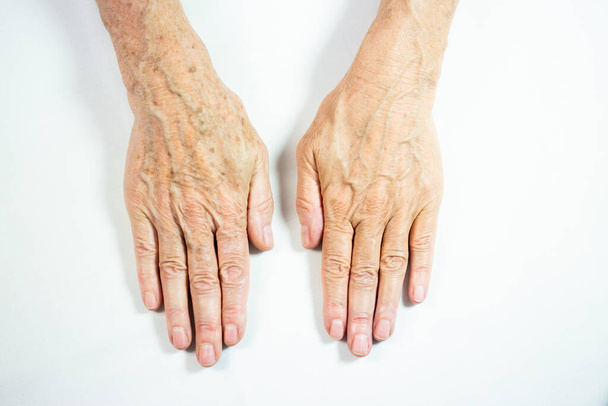 One hand with spots of old age and the other one laser treated. - Fotoğraf, Görsel