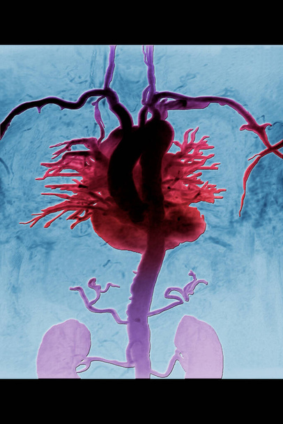 HEART, ANGIOGRAPHY concept background - Photo, Image