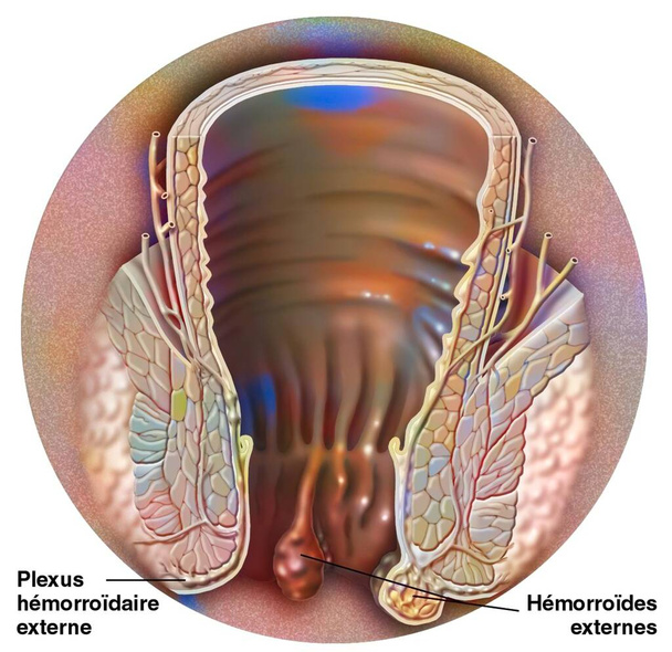 External hemorrhoidal plexus and location of external hemorrhoids. - Photo, image