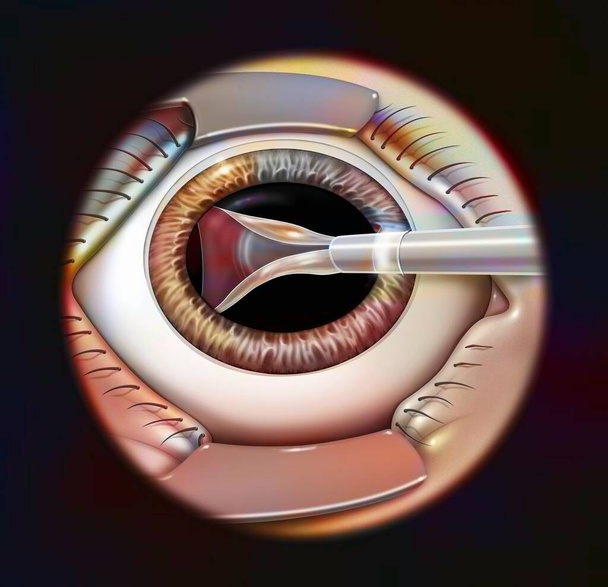 Eye, intraocular implant, step 2: the intraocular implant is folded using forceps. - 写真・画像