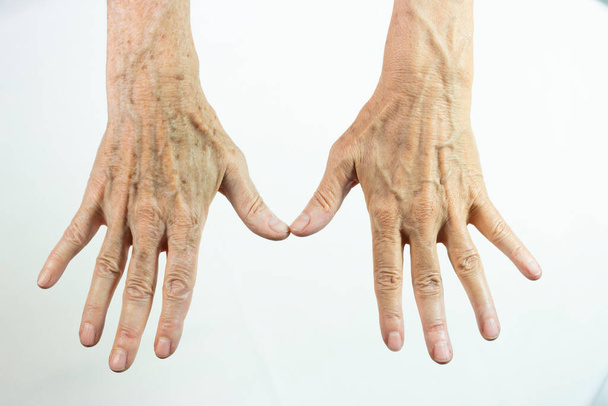 One hand with spots of old age and the other one laser treated - Photo, Image