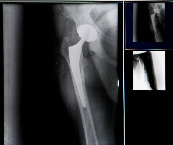 X-ray of the patient's hip after placement of the prosthesis. - Foto, imagen