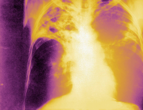 An anteroposterior X-ray of a patient diagnosed with advanced bilateral pulmonary tuberculosis. This AP X-ray of the chest reveals the presence of bilateral pulmonary infiltrate, and caving formation present in the right apical region. - Fotografie, Obrázek