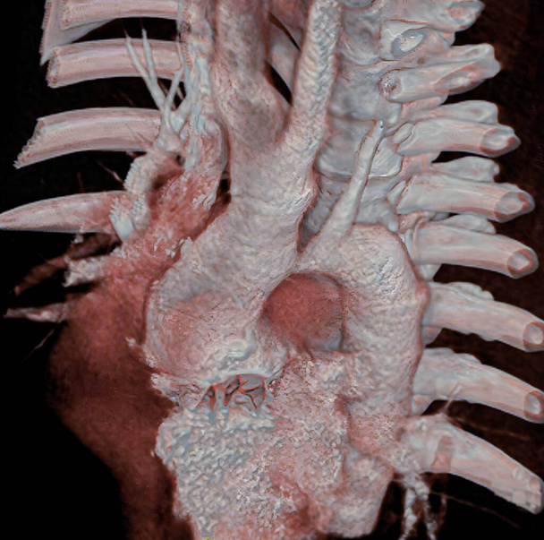 Aortic coarctation is a narrowing of the aorta, often considerable and sometimes complete, most commonly just past the point where the aorta and the subclavian artery meet. Aortic coarctation causes low blood flow, often leading to arterial hypertens - 写真・画像