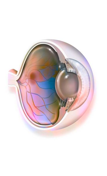 Cutaway eye: macular degeneration (opaque red spot on the macula). - Foto, Imagen