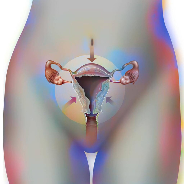 Retraction of the uterus (severed) after childbirth to remove bleeding. - Foto, Bild