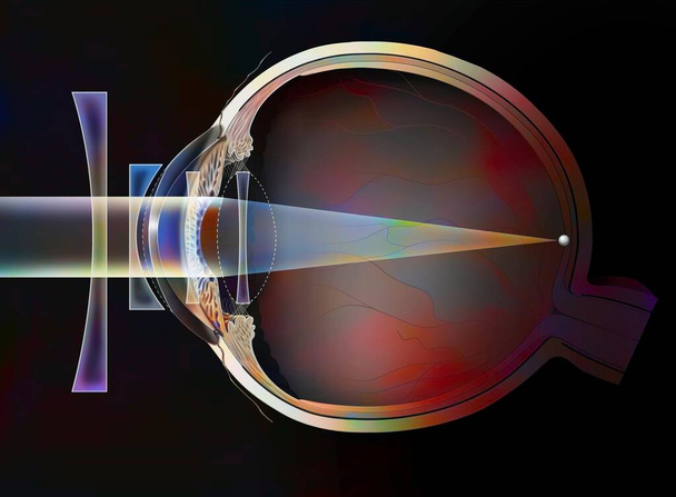 Different possible corrections of a myopic eye: spectacle lenses - external lenses. . - Foto, Imagem