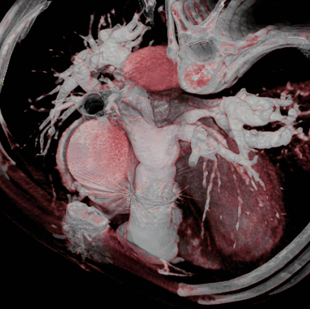 У пациентов, родившихся без легочных артерий, хирургическое вмешательство восстанавливает почти нормальное дерево легочной артерии, прикрепляя родные легочные, артериальные ветви к трубе, помещенной в правый желудочек. 3D компьютерная томография. - Фото, изображение