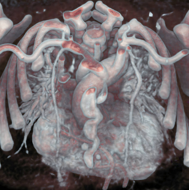 Thorax of newborn : Mediastinum, heart, aorta, and mammary arteries are visible. 3D CT scan. - Foto, Imagen