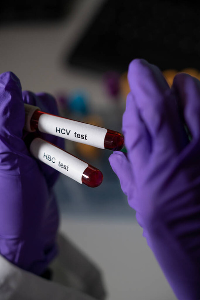 Blood tests for hepatitis B (HBC) and C (HCV) - Photo, image