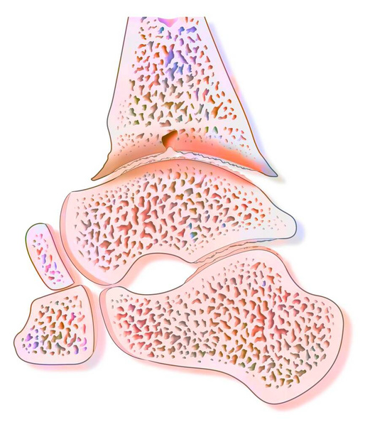 Гемофільна артропатія щиколотки (гематоз
). - Фото, зображення