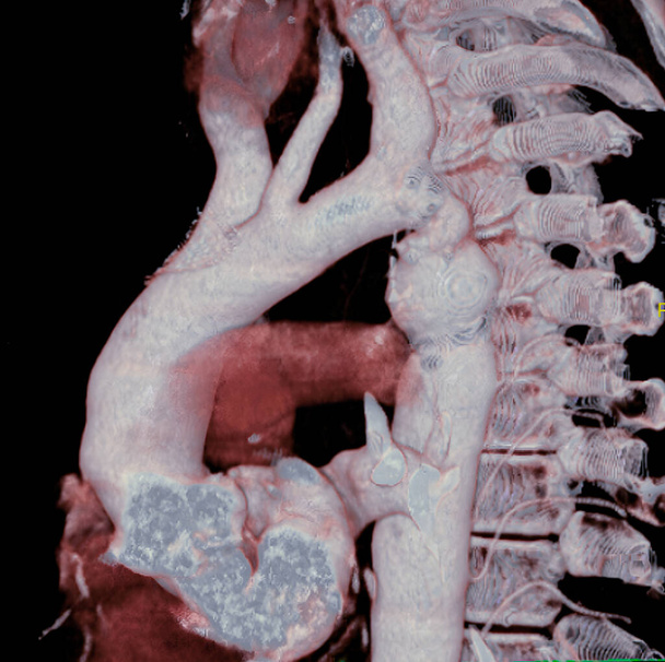 Aortic coarctation. Here, a considerable narrowing of the aorta is visible, just past the point where the aorta and the subclavian artery meet, causing arterial hypertension. 3D CT scan. - Foto, afbeelding