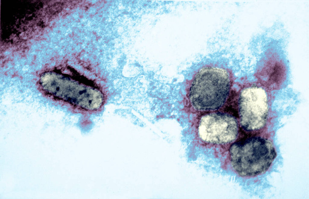 Smallpox virus. This electron micrograph depicts the variola, smallpox virus using a negative stain technique; Magnification 65,000X. Smallpox is a serious, highly contagious, and sometimes fatal infectious viral disease. There is no specific treatme - Foto, Bild