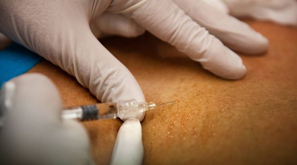 General practitioner practicing mesotherapy and injecting hyaluronic acid into a patient. - Photo, image