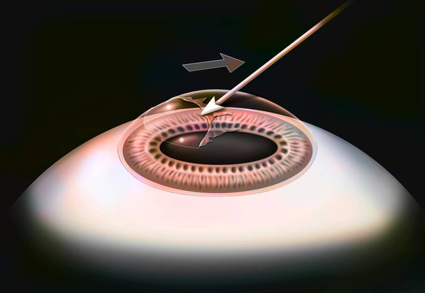 Eye, surgery, photokeractectomy step 3: the corneal epithelium layer is detached. - 写真・画像