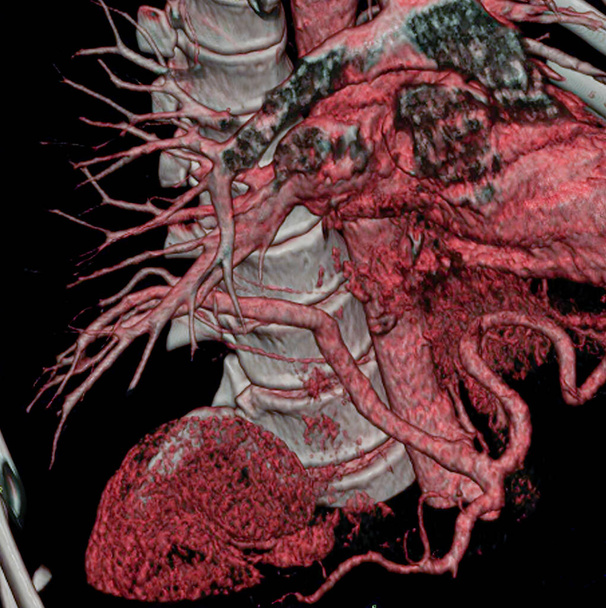 Abnormal vessel originating from the abdominal aorta and vascularizing the right lung. This anomaly, called pulmonary sequestration, can cause pulmonary hemorrhaging (hemoptysis). 3D CT scan. - Zdjęcie, obraz