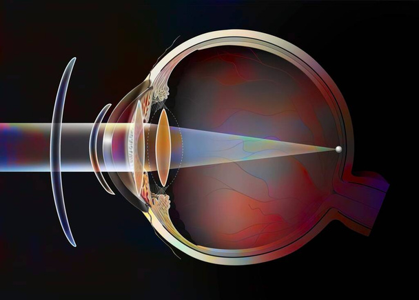 Different possible corrections of a presbyopic eye: spectacle lenses - external lenses. . - Fotografie, Obrázek