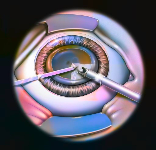 Eye, cataract, phacoemulsification - step 2: consists of breaking the lens with a probe. - Photo, image
