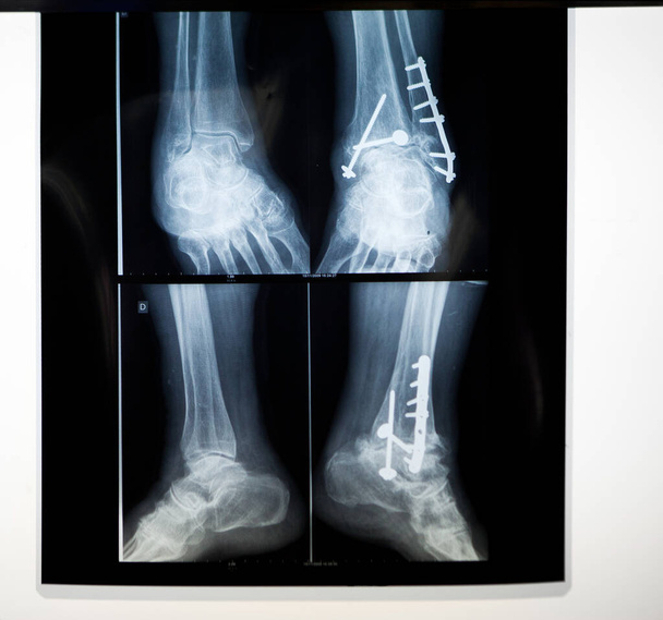 Osteosynthesis: septic surgery for the removal of an internal ankle fixator following an infection. - Foto, Imagen