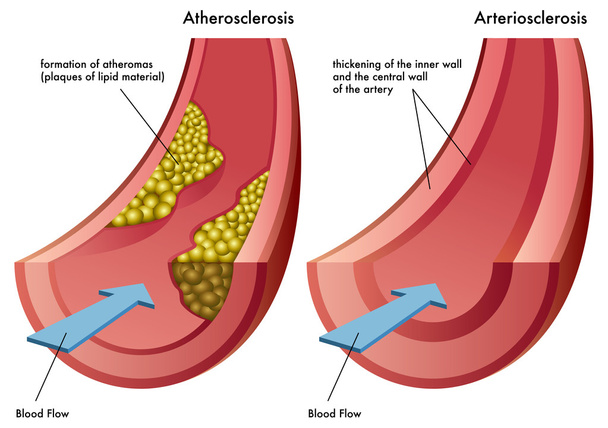 Proces ateriosclerosis - Wektor, obraz