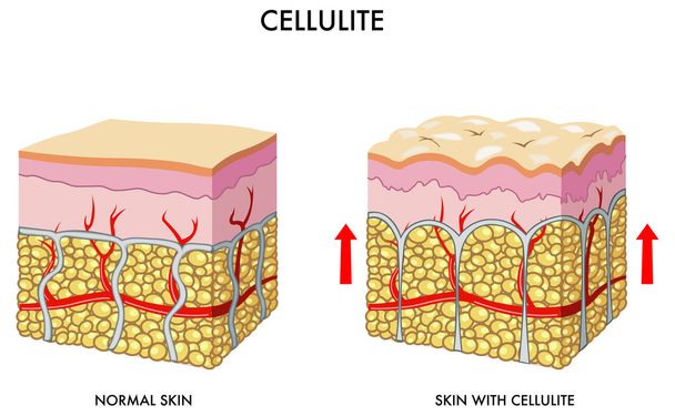 セルライトを示す皮膚の断面図 - ベクター画像