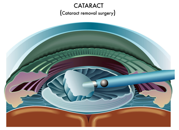 Cataract - Vector, afbeelding