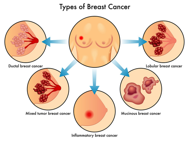 Types of Breast Cancer - Vector, Image