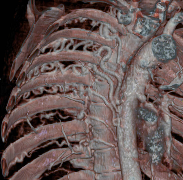 Большие межреберные артерии, видимые при компьютерной томографии, разработаны для компенсации кровотока в легких вследствие врожденного порока сердца, характеризующегося атрезией легочных артерий (малых или отсутствующих легочных артерий). 3D компьютерная томография. - Фото, изображение