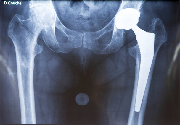 X-ray of a hip prosthesis. - Photo, Image