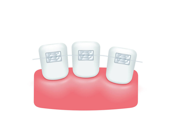 Teeth before braces. Orthodontic treatment style elements. White teeth with metal brackets isolated on white background. Dental care health concept. Realistic 3d vector illustration - Vector, Image
