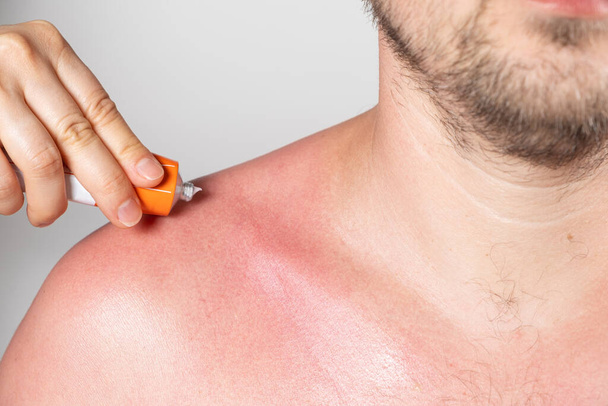 Εφαρμογή θεραπευτικής αλοιφής στο δέρμα ενός ατόμου με ηλιακό έγκαυμα, κοντινό πλάνο - Φωτογραφία, εικόνα
