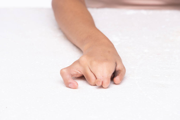 Рука людини з обмеженими можливостями без пальців з дитинства, без великого пальця нігтів на білому тлі ізольовано. Руки жінки показують жест інвалідності з рукою і хірургічним пораненням, щоб розділити палець
 - Фото, зображення