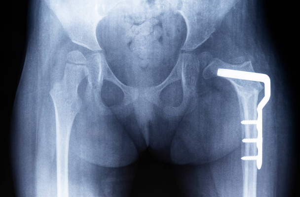 Osteotomy of the hip joint. Film radiograph of the pelvis shows dysplasia of the left thigh, metal plate - Foto, imagen