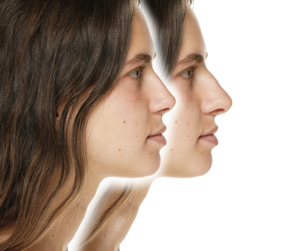 Fiatal nő előtt és után plasztikai műtét az orr fehér alapon. - Fotó, kép