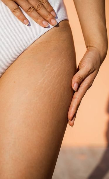 Stretch marks on female legs. A woman's hand holds a fat cellulite and a stretch mark on her leg. Cellulite close-up. - Foto, imagen