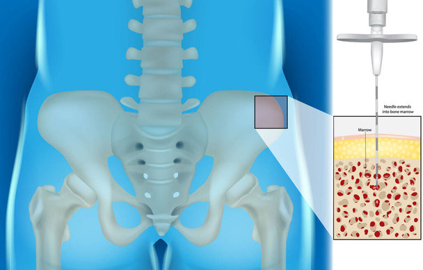 Bone Marrow Aspiration And Biopsy. Illustration of the Needle extends into bone marrow. Hematology - Vector, imagen
