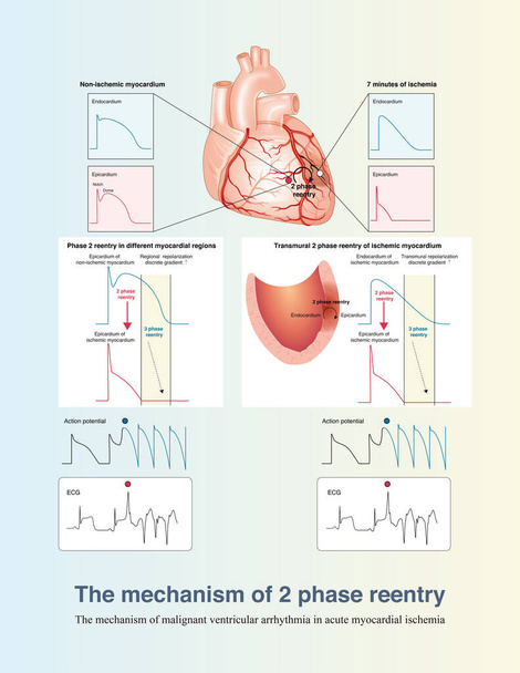 На ранней стадии острой трансмуральной ишемии миокарда механизм желудочковой аритмии, в основном, состоит из 2 фаз, включая возврат между ишемической и неишемической зонами и возвращение через стенку желудочка.. - Фото, изображение