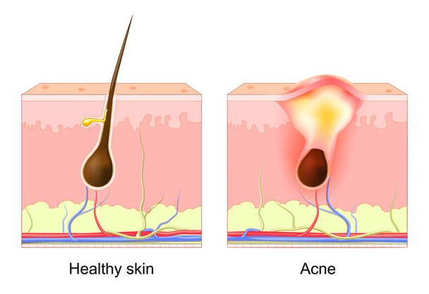 Acne pimple. normal hair follicle and clogged pore. Difference between healthy skin layer and Acne. dermatology diagram. Acne pimple patch. vector illustration - Vektor, obrázek