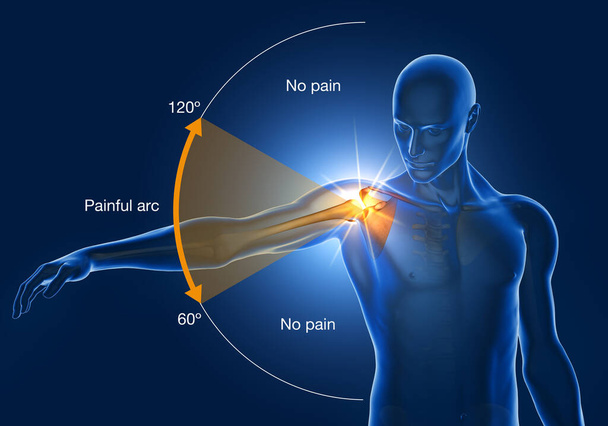 Illustration showing shoulder impingement, painfull arc, 3D illustration - Foto, imagen