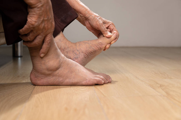 Senior woman massage foot with painful swollen gout inflammation - 写真・画像