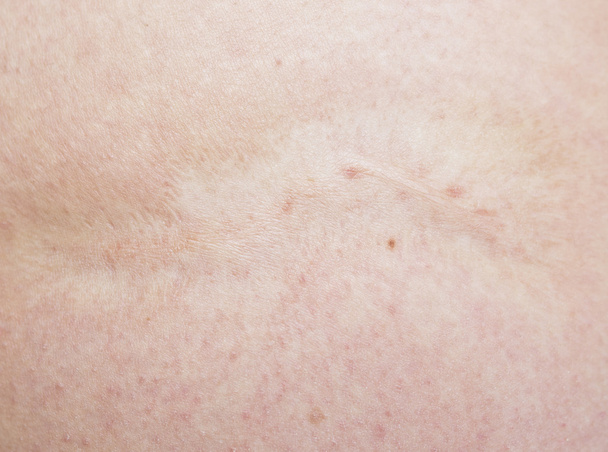 scar - Photo, Image